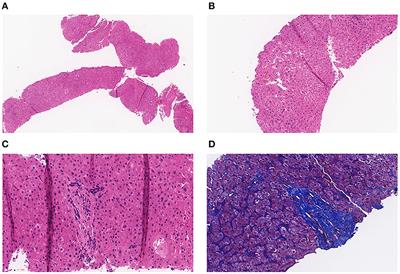 Case report: Oxaliplatin-induced idiopathic non-cirrhotic portal hypertension: a case report and literature review